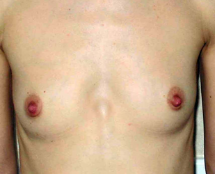 chirurgie-esthetique-interventions-seins-augmentations-mammaires-031