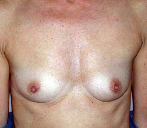 chirurgie-esthetique-interventions-seins-augmentations-mammaires-037