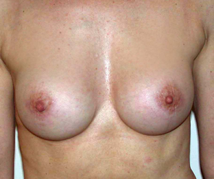 chirurgie-esthetique-interventions-seins-augmentations-mammaires-038