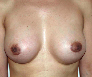 chirurgie-esthetique-interventions-seins-augmentations-mammaires-042