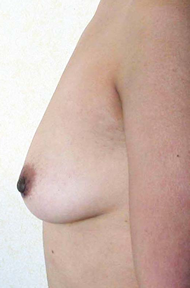chirurgie-esthetique-interventions-seins-augmentations-mammaires-043