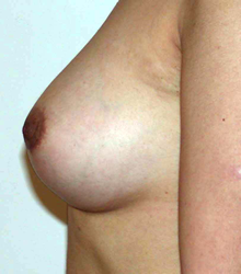 chirurgie-esthetique-interventions-seins-augmentations-mammaires-044