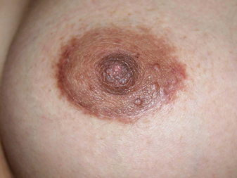 chirurgie-esthetique-interventions-seins-augmentations-mammaires-045