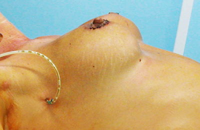 chirurgie-esthetique-interventions-seins-augmentations-mammaires-047