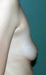 chirurgie-esthetique-interventions-seins-augmentations-mammaires-048