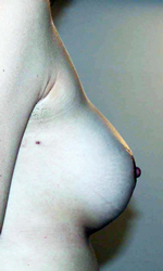 chirurgie-esthetique-interventions-seins-augmentations-mammaires-049