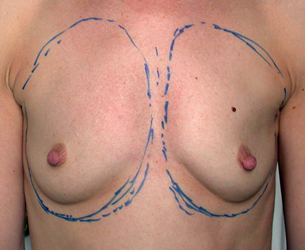chirurgie-esthetique-interventions-seins-augmentations-mammaires-050