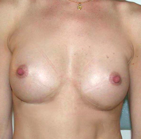 chirurgie-esthetique-interventions-seins-augmentations-mammaires-051