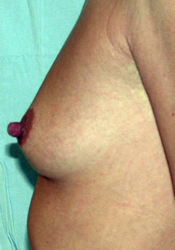 chirurgie-esthetique-interventions-seins-augmentations-mammaires-052