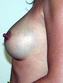 chirurgie-esthetique-interventions-seins-augmentations-mammaires-053