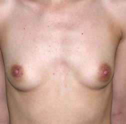 chirurgie-esthetique-interventions-seins-augmentations-mammaires-054