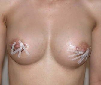 chirurgie-esthetique-interventions-seins-augmentations-mammaires-055