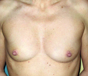 chirurgie-esthetique-interventions-seins-augmentations-mammaires-056