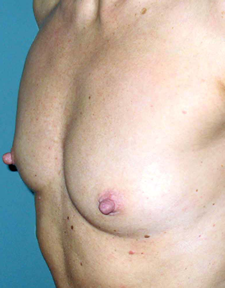 chirurgie-esthetique-interventions-seins-augmentations-mammaires-058