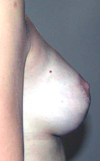 chirurgie-esthetique-interventions-seins-correction-ptose-avec-implants-11