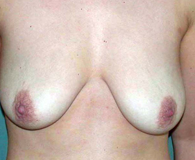 chirurgie-esthetique-interventions-seins-correction-ptose-avec-implants-16