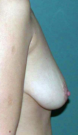 chirurgie-esthetique-interventions-seins-correction-ptose-avec-implants-18