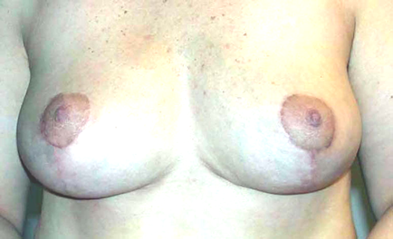 chirurgie-esthetique-interventions-seins-reductions-mammaires-01