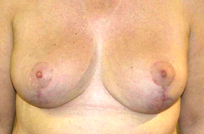 chirurgie-esthetique-interventions-seins-reductions-mammaires-03