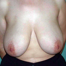 chirurgie-esthetique-interventions-seins-reductions-mammaires-06