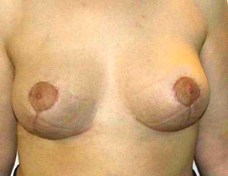 chirurgie-esthetique-interventions-seins-reductions-mammaires-07