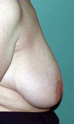 chirurgie-esthetique-interventions-seins-reductions-mammaires-08