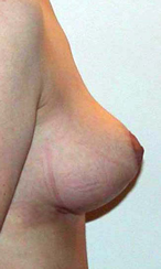 chirurgie-esthetique-interventions-seins-reductions-mammaires-09