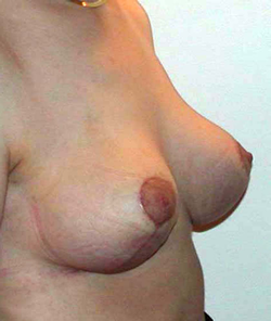 chirurgie-esthetique-interventions-seins-reductions-mammaires-10