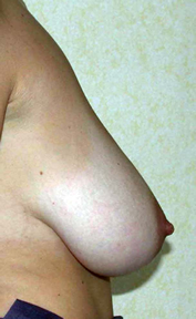 chirurgie-esthetique-interventions-seins-reductions-mammaires-13