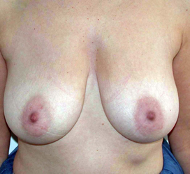 chirurgie-esthetique-interventions-seins-reductions-mammaires-18