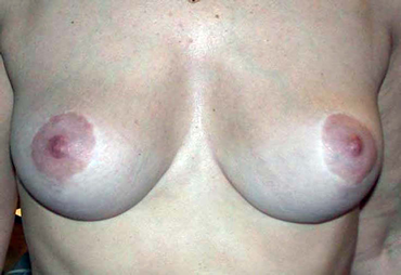 chirurgie-esthetique-interventions-seins-reductions-mammaires-19