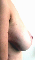 chirurgie-esthetique-interventions-seins-reductions-mammaires-20