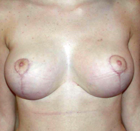 chirurgie-esthetique-interventions-seins-reductions-mammaires-25