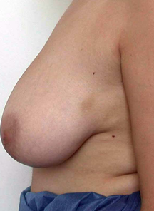 chirurgie-esthetique-interventions-seins-reductions-mammaires-28
