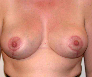 chirurgie-esthetique-interventions-seins-reductions-mammaires-33