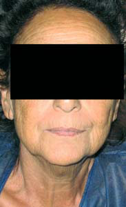 chirurgie-esthetique-interventions-visage-liftings-000