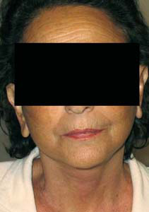 chirurgie-esthetique-interventions-visage-liftings-001