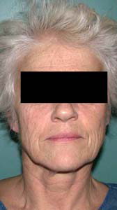 chirurgie-esthetique-interventions-visage-liftings-002