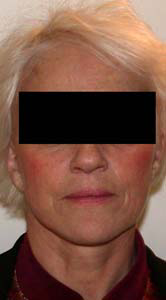 chirurgie-esthetique-interventions-visage-liftings-003