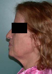 chirurgie-esthetique-interventions-visage-liftings-004