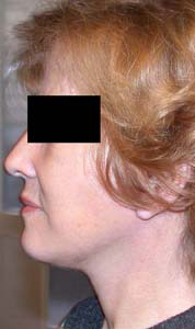 chirurgie-esthetique-interventions-visage-liftings-005