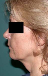 chirurgie-esthetique-interventions-visage-liftings-006
