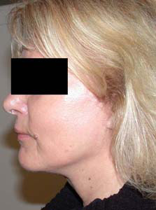 chirurgie-esthetique-interventions-visage-liftings-007
