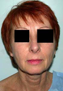 chirurgie-esthetique-interventions-visage-liftings-008
