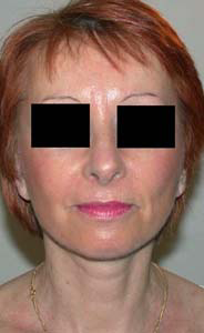 chirurgie-esthetique-interventions-visage-liftings-009