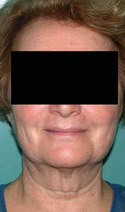 chirurgie-esthetique-interventions-visage-liftings-010