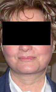 chirurgie-esthetique-interventions-visage-liftings-011