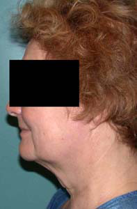 chirurgie-esthetique-interventions-visage-liftings-012