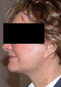 chirurgie-esthetique-interventions-visage-liftings-013