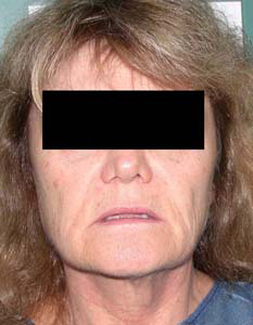 chirurgie-esthetique-interventions-visage-liftings-014